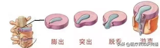 如何正确认识腰椎间盘突出症,简单两招有效缓解腰椎间盘突出症