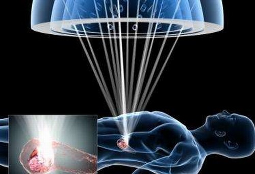放射治疗什么意思,放射治疗是什么手段