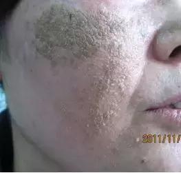 洗脸洗多了毛孔变大怎么办,洗脸洗成痘痘肌