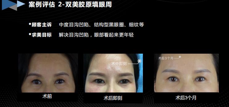 胶生灌养眼周抗衰是什么产品?