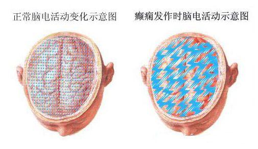 遗传性癫痫发作诱因,3年发作一次癫痫有诱因