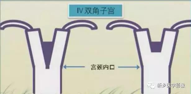 子宫发育异常，应想到的6大类常见畸形