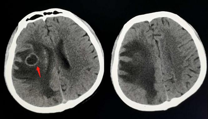 网吧小伙感染肺结核,在网吧得了肺结核