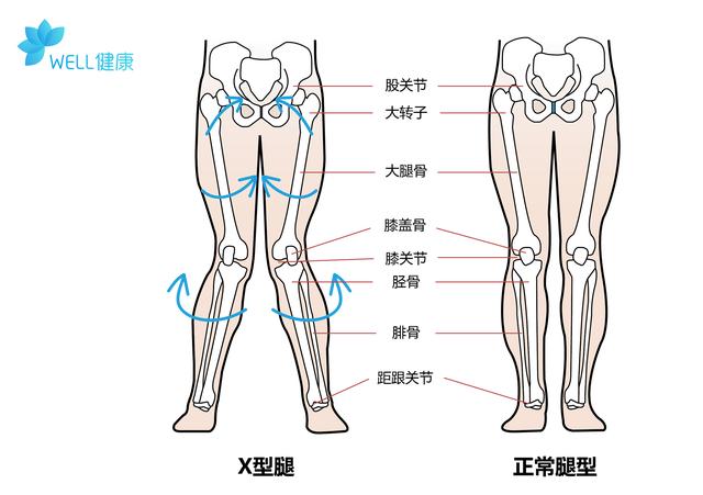 孩子x型腿需要矫正吗,孩子x型腿怎么治疗
