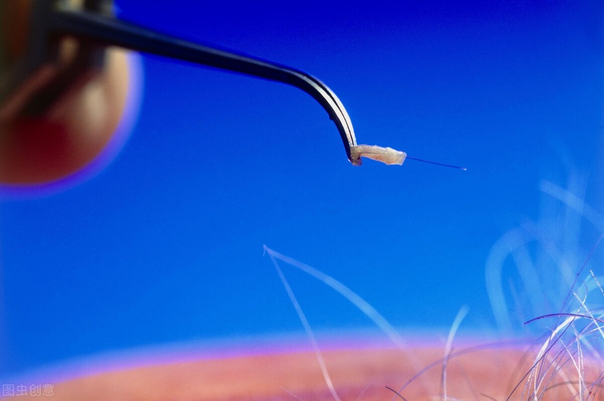 植发后怎么才能长得更好,植发之后和本来的头发有区别吗