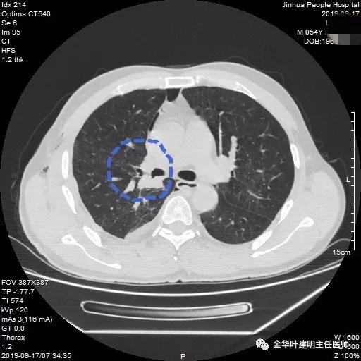 省级医院也漏诊?还好没耽误病情!我们予以行右中下叶袖式切除术
