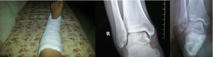 踝关节扭伤正确的处理方式是什么,踝关节扭伤的表现及处理方法