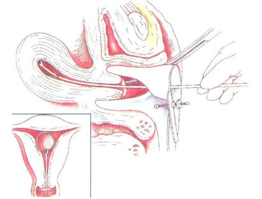 环节育器,避孕环和避孕器