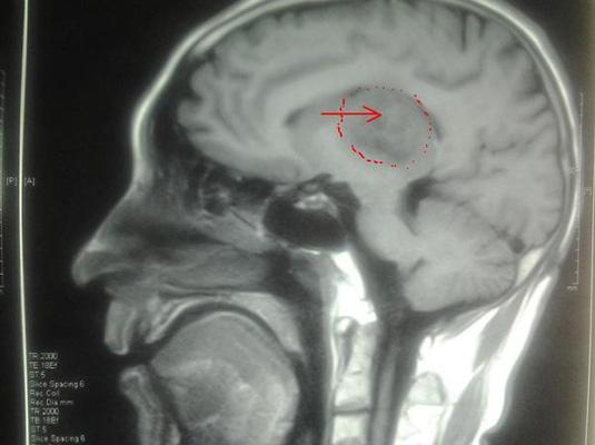 放射治疗射线作用时间,放射激光治疗