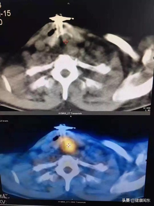 福建民间治疗癌症老中医,广东乡下老中医治疗癌症偏方