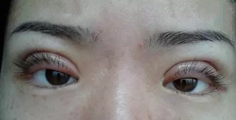 双眼皮不满意能改善吗,双眼皮不对称医院是免费修复的吗