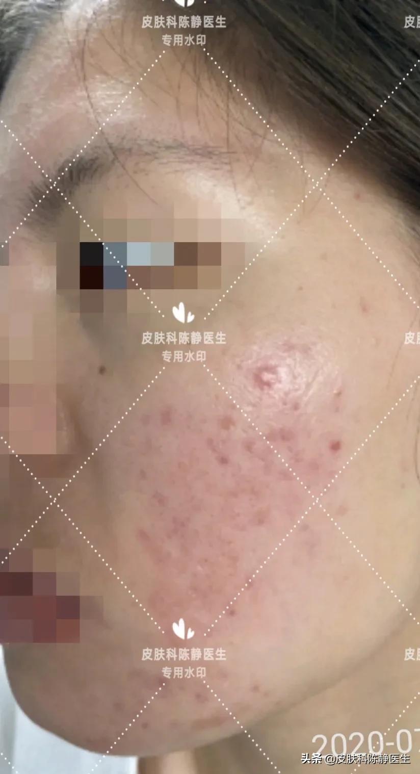 暗疮和青春痘有什么区别,痤疮青春痘常见十八问