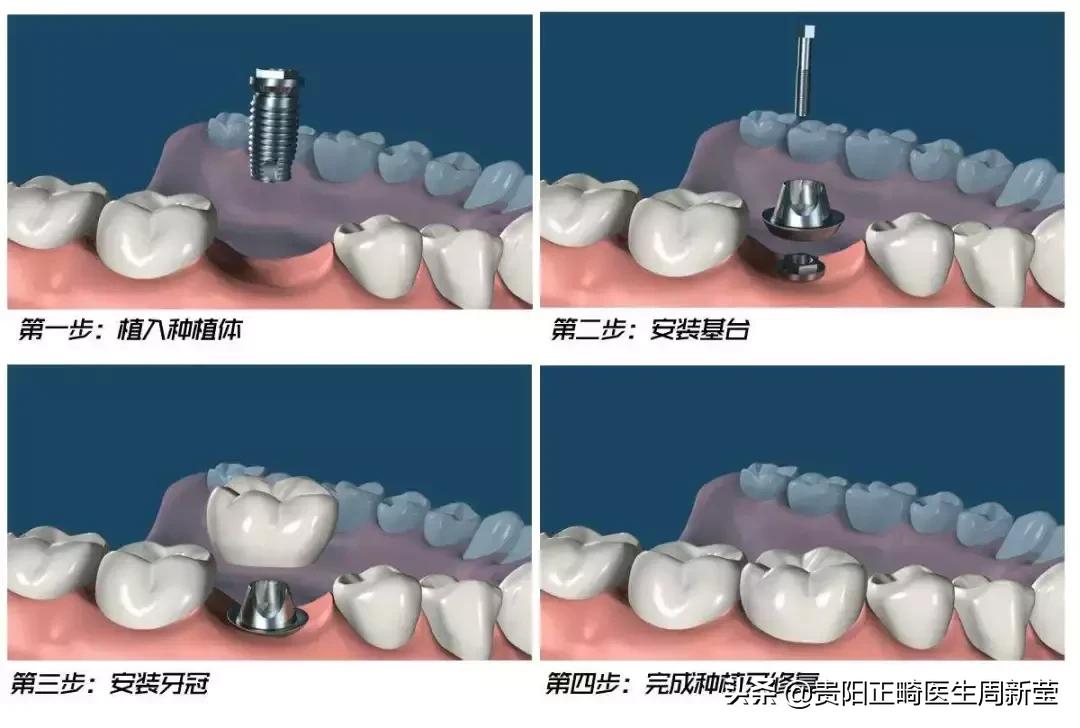 为什么镶完假牙以后有口臭,为什么镶牙之后感觉牙齿酸软痛