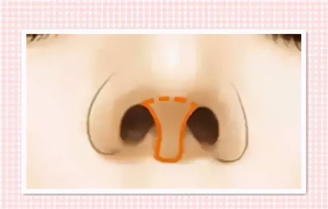 先天鼻小柱内凹的原因,鼻小柱往里凹怎么办