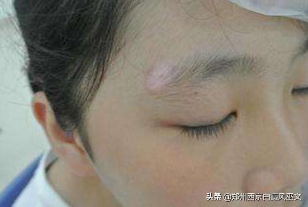 小儿白癜风高发怎么办,2岁儿童怎么确诊白癜风最准确