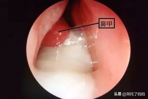 宝宝鼻涕颜色能反映出病情,宝宝鼻涕什么样算快好了