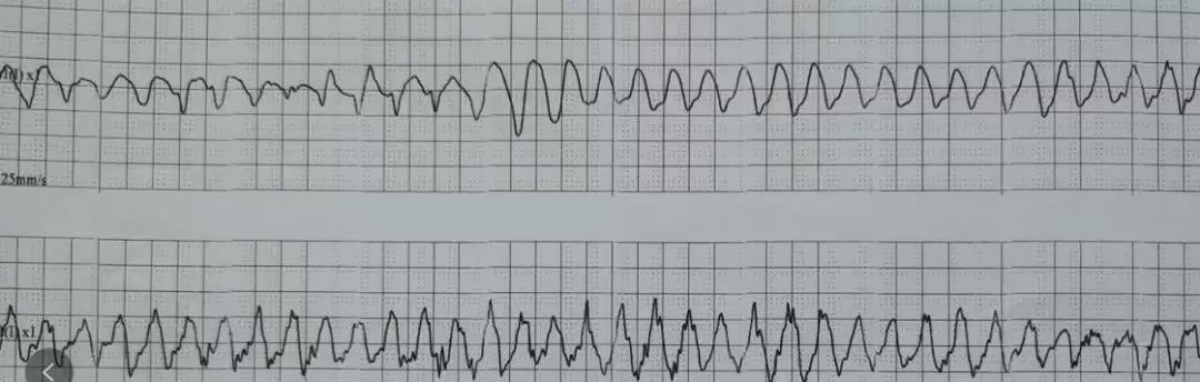 检查心脏心电图,检查心脏彩超是最好的吗