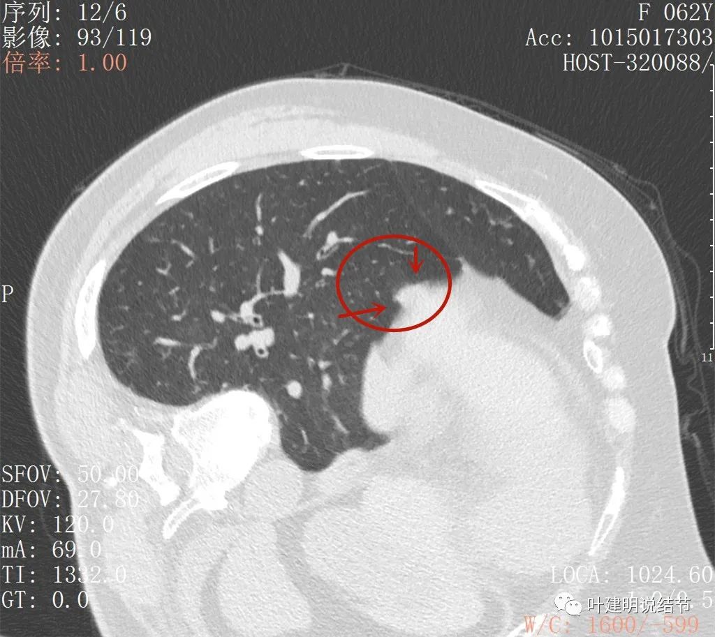 左肺癌手术半年右肺下角还有炎症,左下肺癌晚期