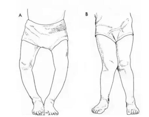 宝宝七八个月站太早容易得o型腿,7个月宝宝要走路咋办