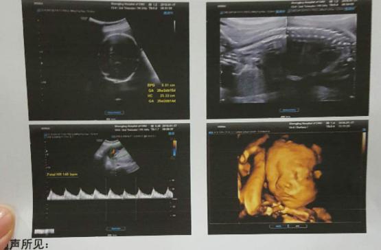 七种孕妇容易出唐氏儿,40岁孕妇唐氏筛查出高风险