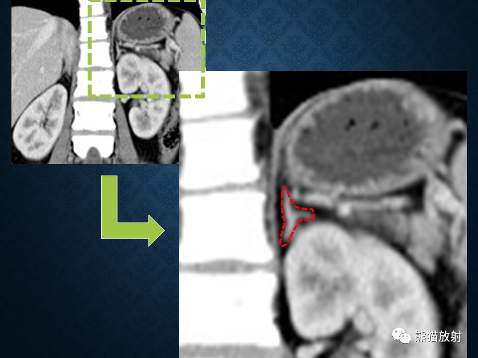 纵隔和肾上腺恶性肿瘤,纵隔性肿瘤位置图