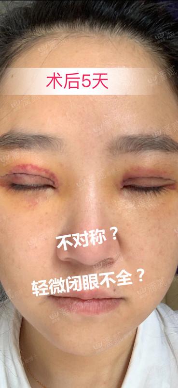 双眼皮修复要对医生说实话吗,双眼皮失败可以修复的几率有多大