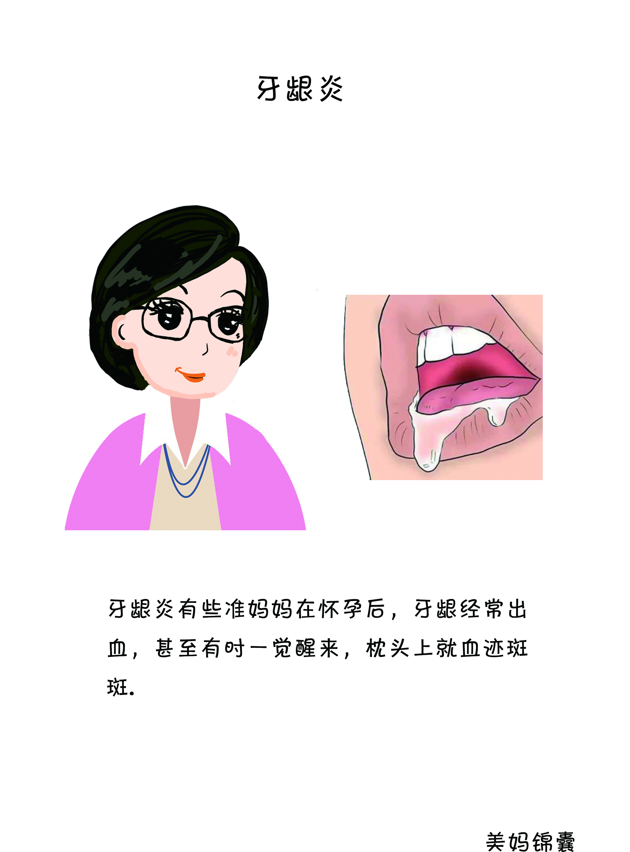 孕期牙龈炎怎么办,孕期牙龈炎使用什么牙膏