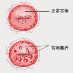 妇科检查宫颈囊肿严重吗,宫颈囊肿的危害有哪些呢