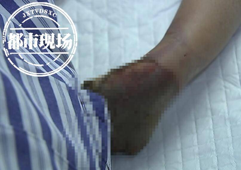 7岁男童意外电击伤右臂截肢,男童被电击右臂截肢大家捐钱