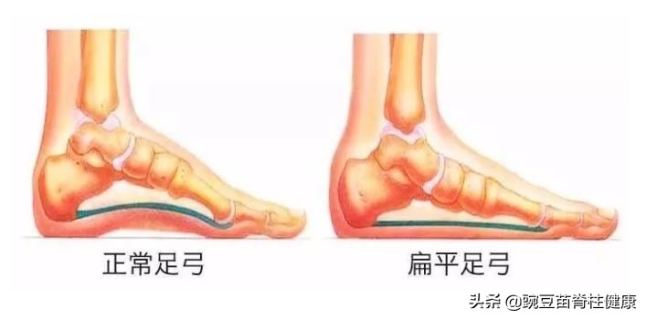小孩走路弓腰驼背练什么锻炼气质,小孩子改善驼背和脖子前倾的运动