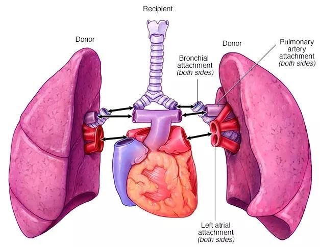 先天性心脏病主动脉与肺动脉,先天性心脏病肺动脉高压的表现