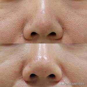 白醋洗脸控油还美白,白醋洗脸真的可以改善痤疮吗