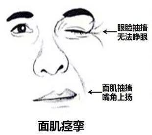 面肌痉挛是面瘫吗,中医治面肌痉挛