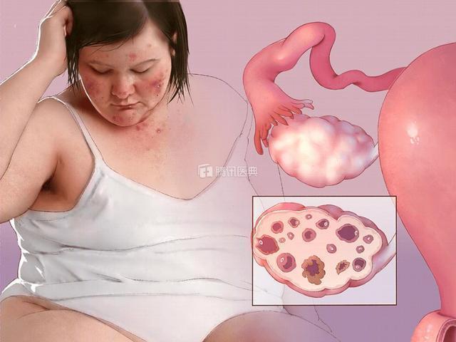 临床常用于男子少精的复方玄驹胶囊为何可用于多囊卵巢综合征？