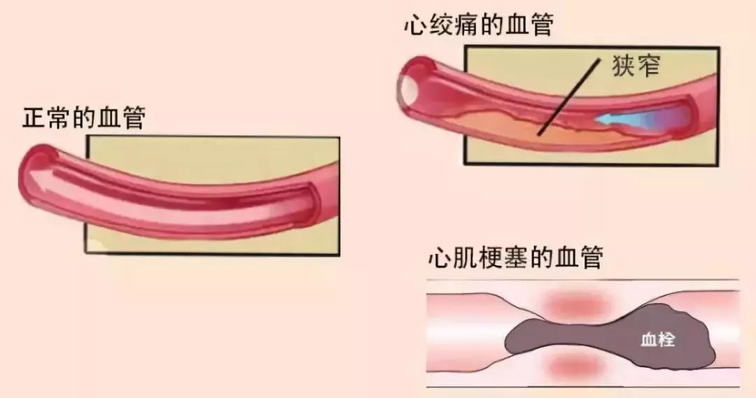 血管有杂质是什么症状,血管里有垃圾和毒素吗