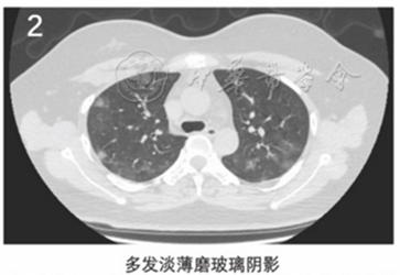 新冠肺炎胸片影像学表现有哪些,新冠肺炎患者轻微症状肺部ct表现