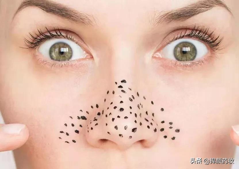 为什么黑头总是挤不完,脸上黑头粉刺用什么办法快速解决