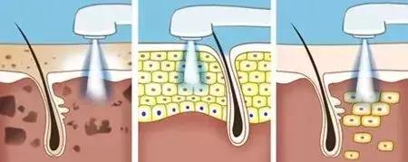 做光子嫩肤好还是用面膜好,做光子嫩肤和护肤哪个效果好