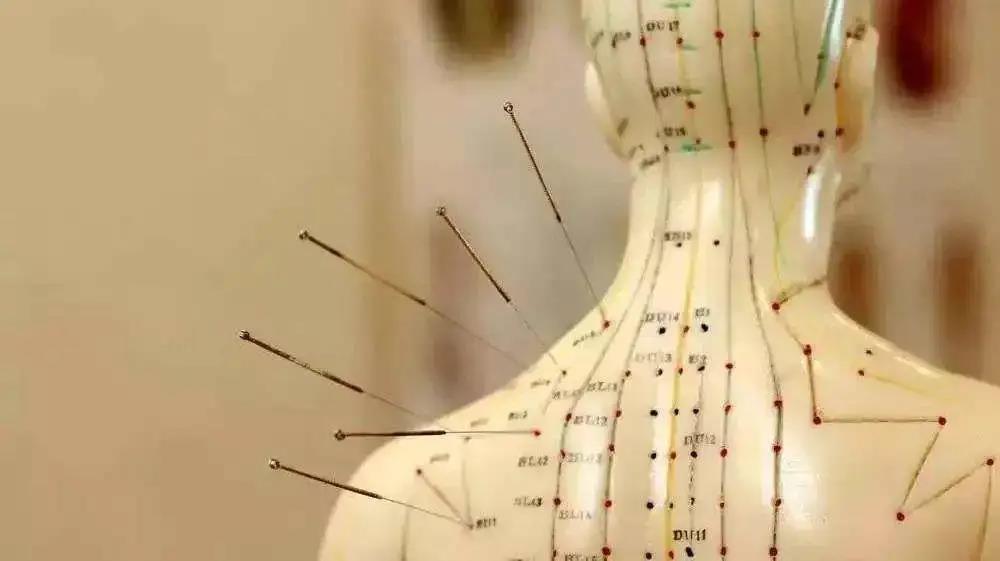 针灸推拿传承中医文化,中医针灸传承1200年