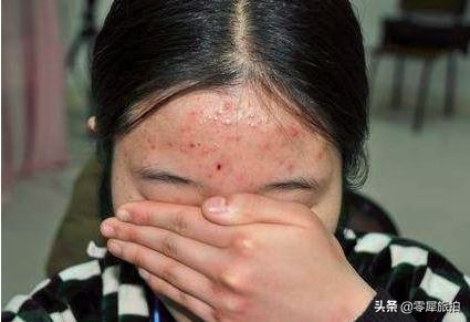 女生脸上长痘痘怎么内调,女生脸上长痘痘怎么办用什么补水