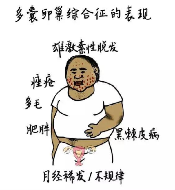 关于多囊卵巢综合症的16个问答,pcos多囊卵巢综合征的临床表现