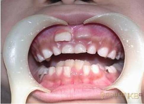 宝宝嘴里有白色的小点叫什么,一个月宝宝口腔上颚白色的是什么