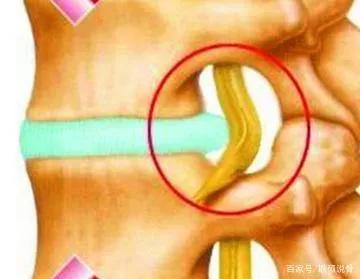 颈椎腰腿痛治疗手法,老中医治疗颈椎腰腿疼
