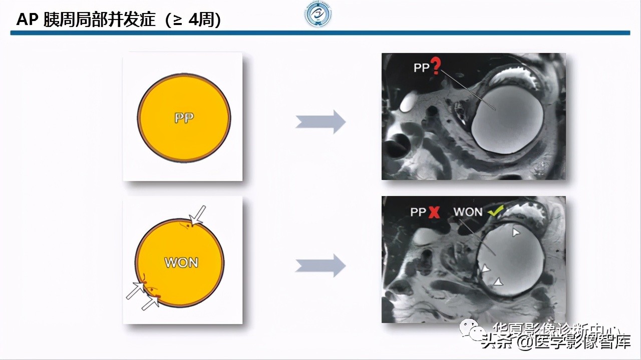 核磁ct都显示急性胰腺炎,急性坏死性胰腺炎的ct表现