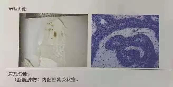 中年人血尿癌症几率是多少,老年人血尿是膀胱肿瘤吗