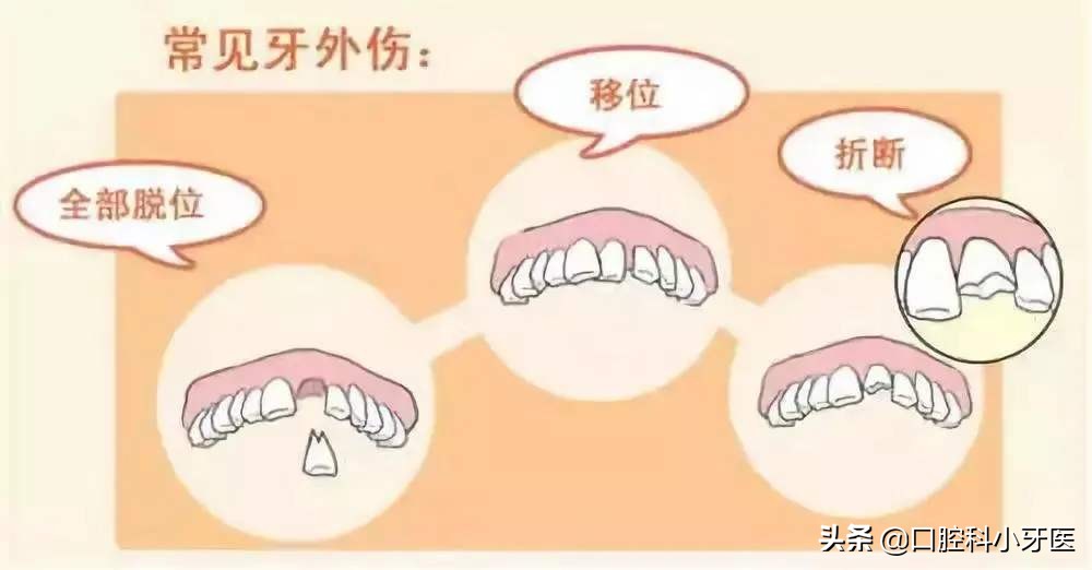 门牙马上要掉了怎么办,门牙连根掉了时间长还能安上吗