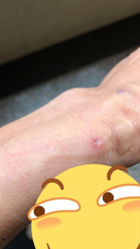 15年痔疮患者的真实经历,重度痔疮的真实案例