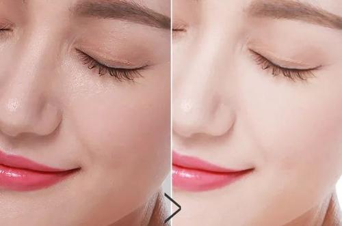 今天治疗，明天上班，激光中的“法拉利”超皮秒