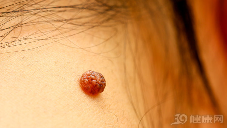 点痣可以阻止癌变吗,女孩点痣好了后面还会复发吗