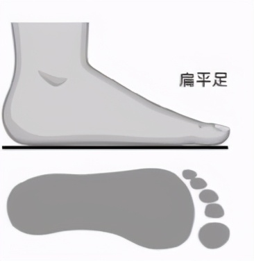 有一种病叫走路就痛,行走性疼痛是怎么了